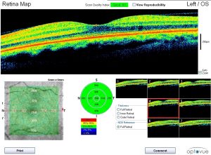 OCT Scan for Macular Degeneration 