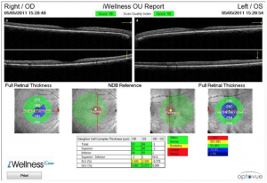 optovue-oct-image